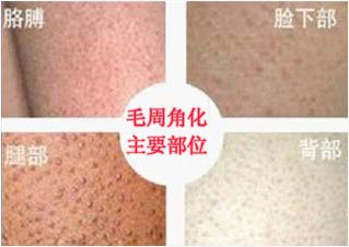 毛周角化症状
